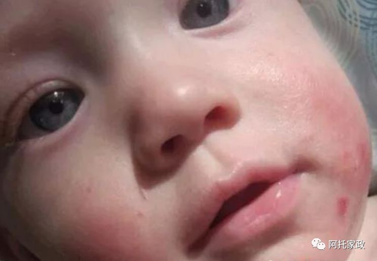 阿托母嬰 | 寶寶濕疹怎么老是不好?阿托月嫂來告訴您 阿托母嬰 | 寶寶濕疹怎么老是不好?阿托月嫂來告訴您